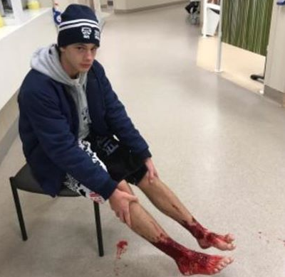 Austrālijā kāds pusaudzis vērsās slimnīcā ar ārkārtīgi neparastām brūcēm uz kājām