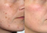 Ietekmīgs dermatologs parādīja, kā atbrīvoties no brūnajiem pleķiem uz sejas ādu ar šo vienkāršo triku!