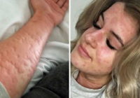 21-gadīga meitene cieš no „alerģijas pret ziemu”. Tas patiešām ir briesmīgi! Vai tiešām tā var būt!?